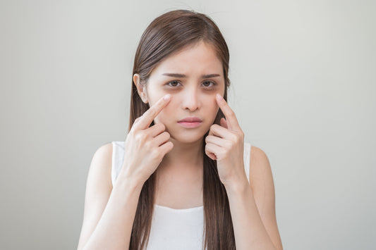 黑眼圈怎麼消除？教你改善4大類型黑眼圈和了解形成原因